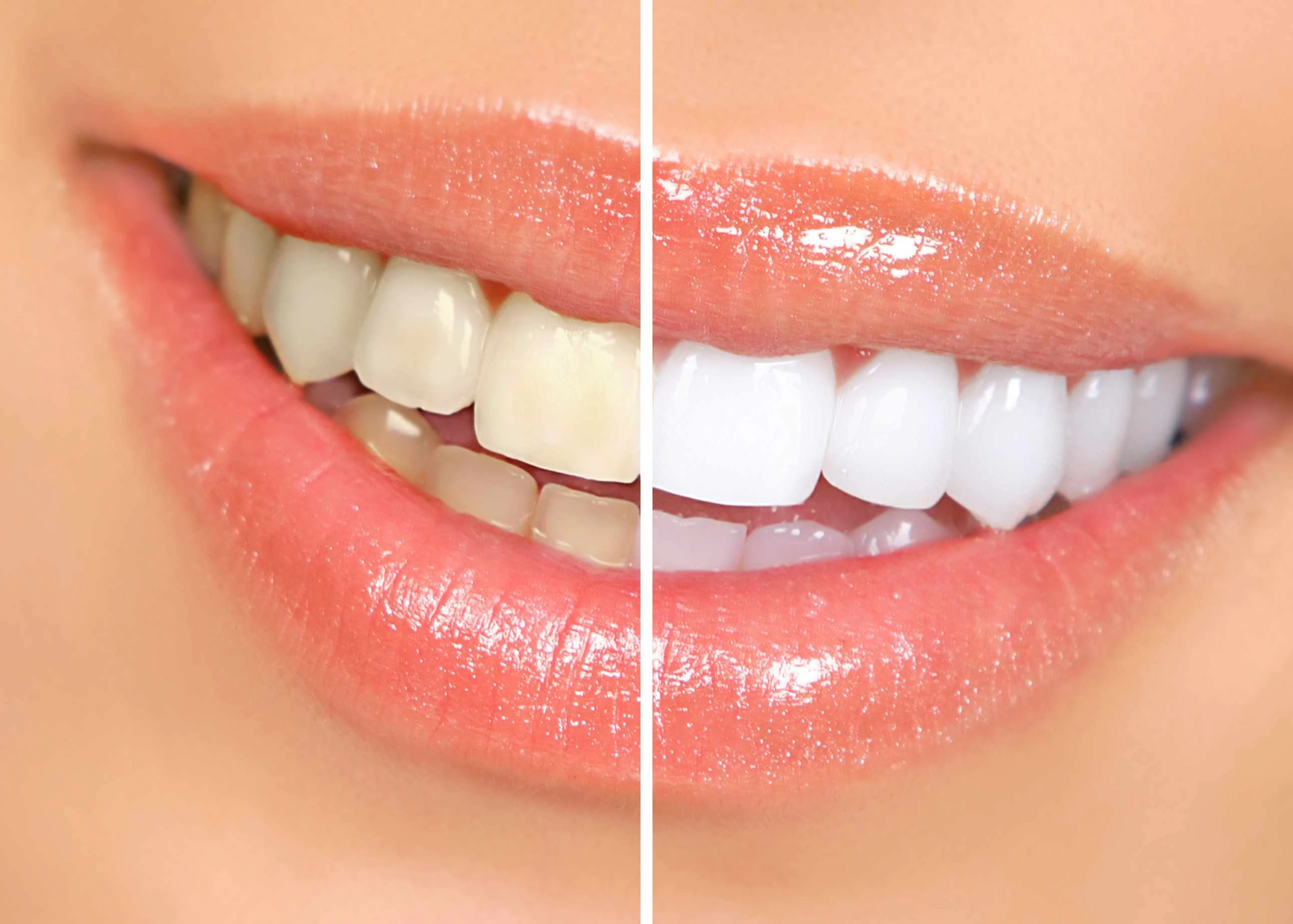 Invisible aligners treatment in pune