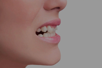 crooked teeth treatment